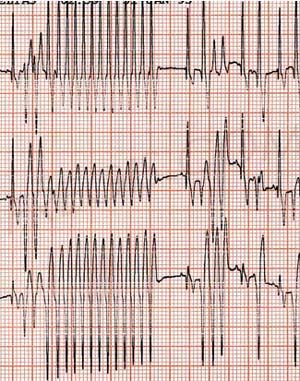 troubles du rythme cardiaque sur électrocardiograme